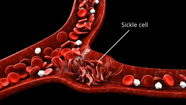 Sicklecellanemi Animering